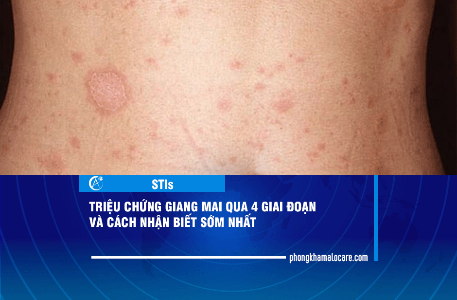 triệu chứng giang mai